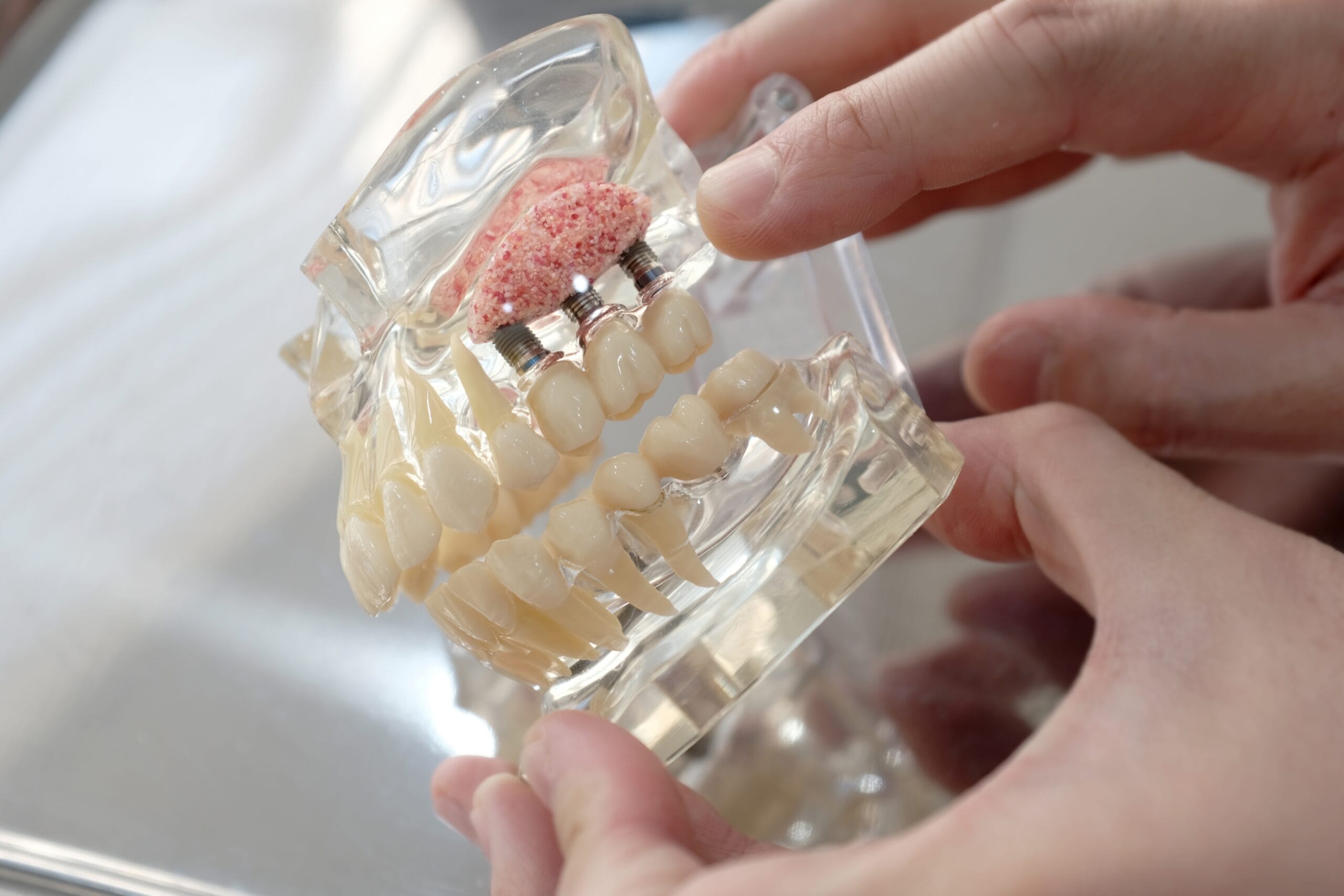 What is a Dental Bone Graft? A Comprehensive Guide