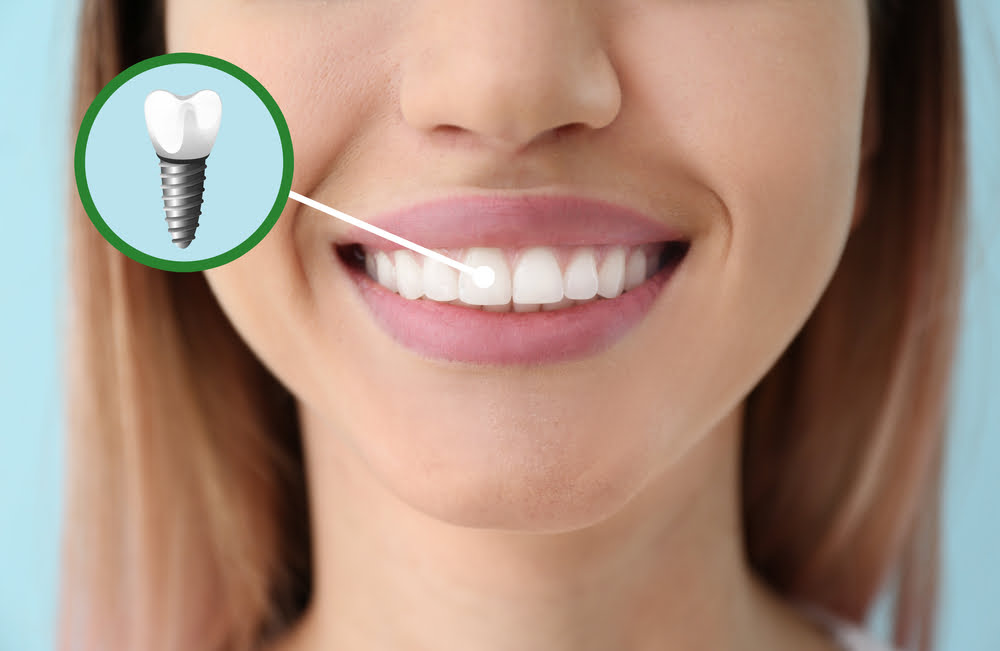 Dental Implants in Jamaica, NY