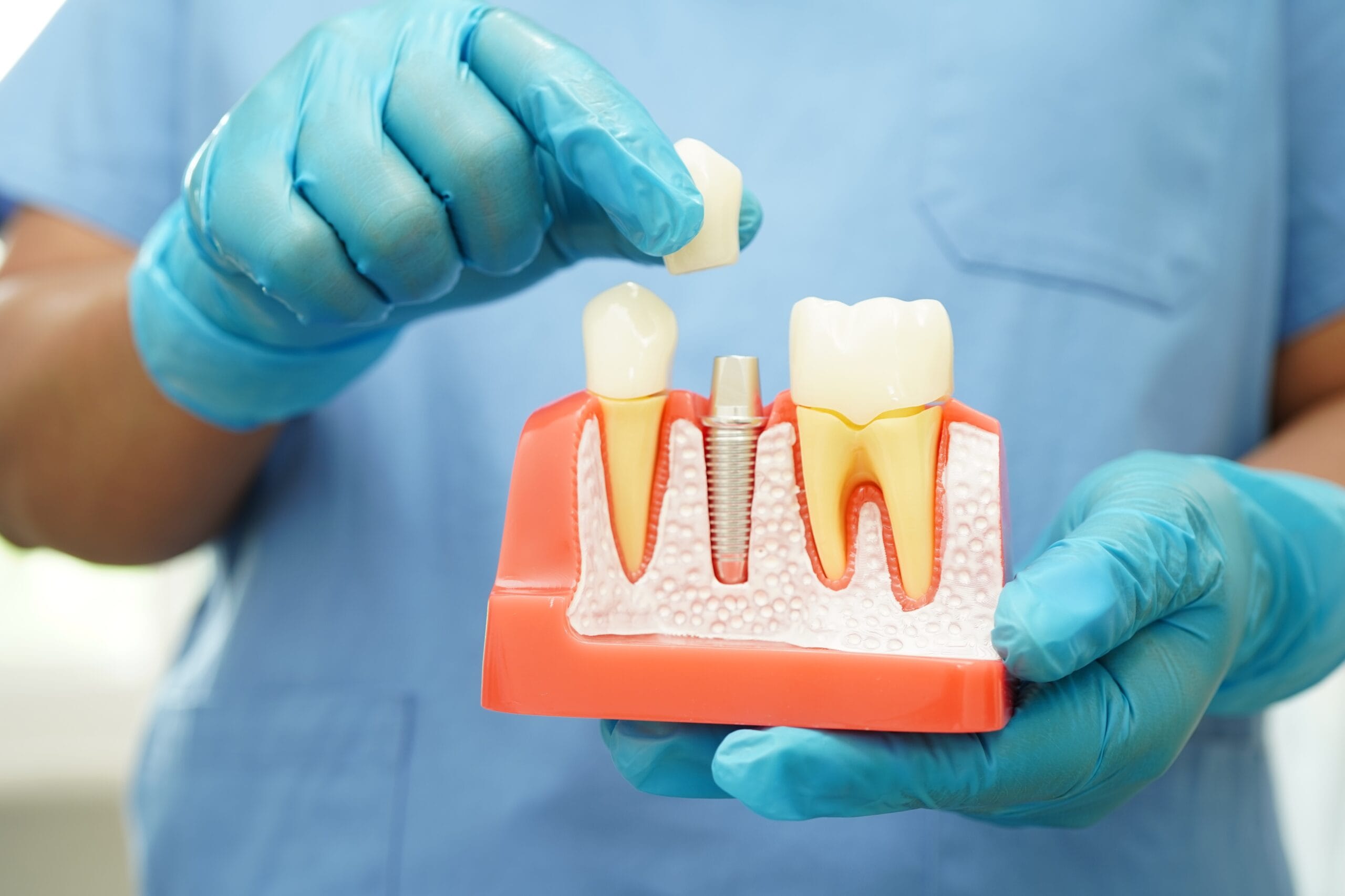 How Long Do Dental Implants Last? A Comprehensive Guide to Proper Implant Care